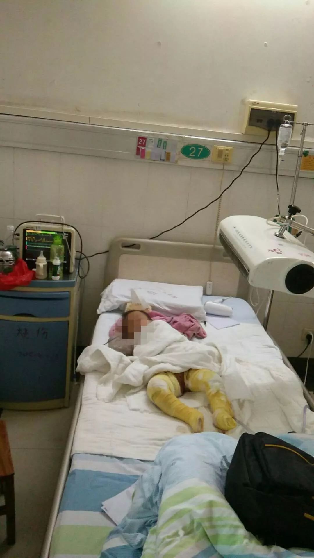玉林一岁女童被开水严重烫伤却无钱医治!她还小,我们不想放弃!