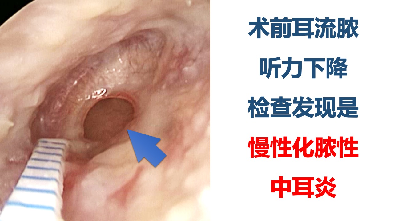 典型病例:耳內鏡微創手術治療慢性化膿性中耳炎