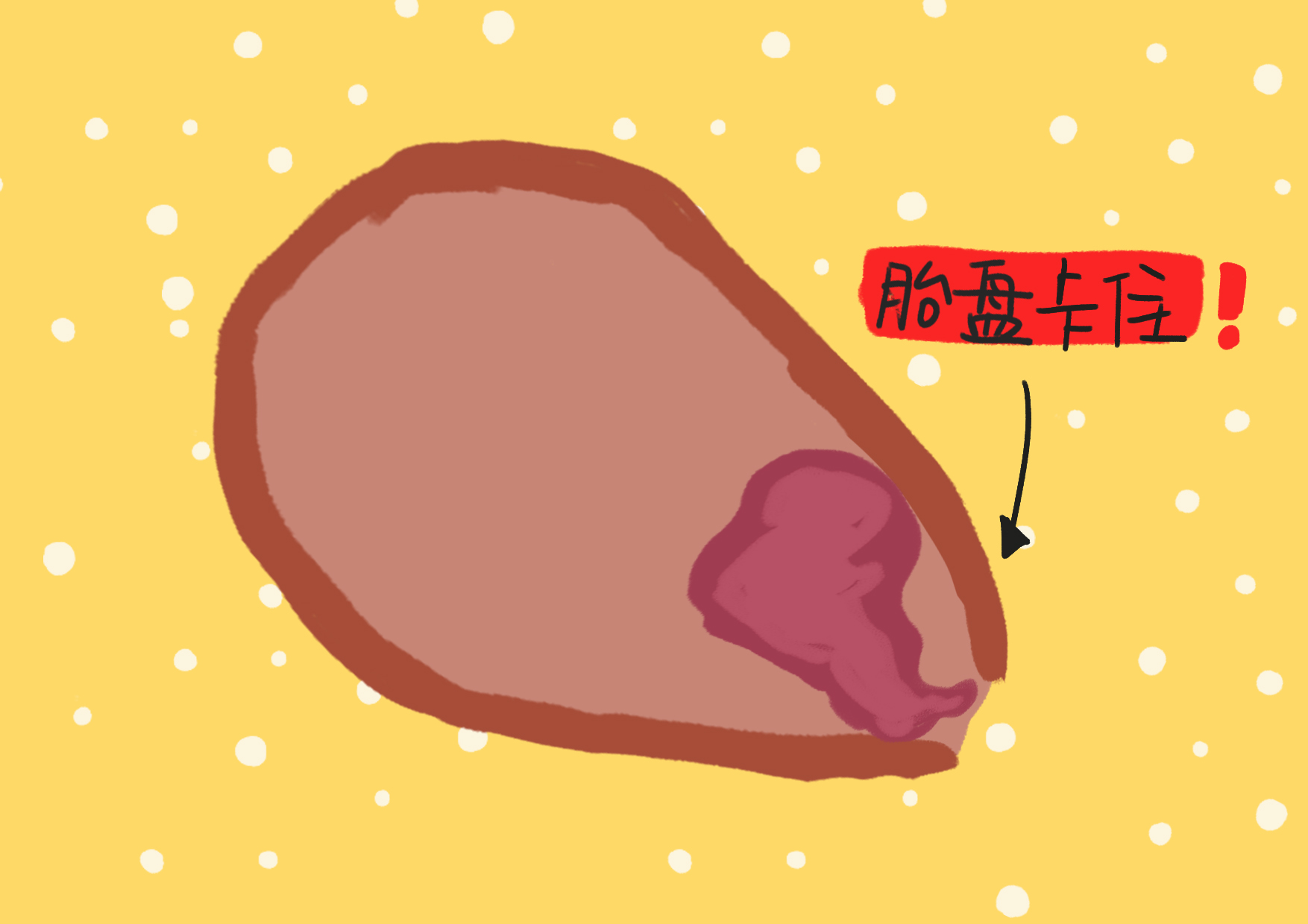 分娩害怕遇到什么?不是分娩阵痛,也不是顺转剖,是"手剥胎盘"