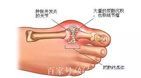 痛风为何从脚而起,又该如何缓解症状呢?