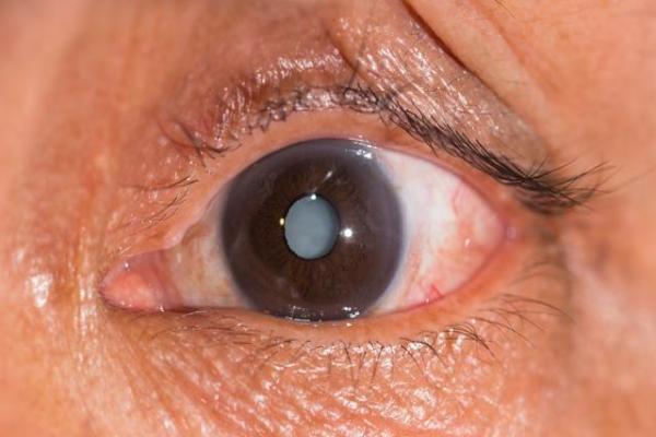 上了年纪,不想因白内障而失明,这个早期信号要及时抓住