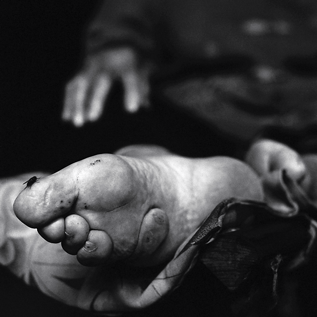 寸金莲,可见女性的脚已经完全变形,脚趾已经紧贴着脚底,就连骨头都