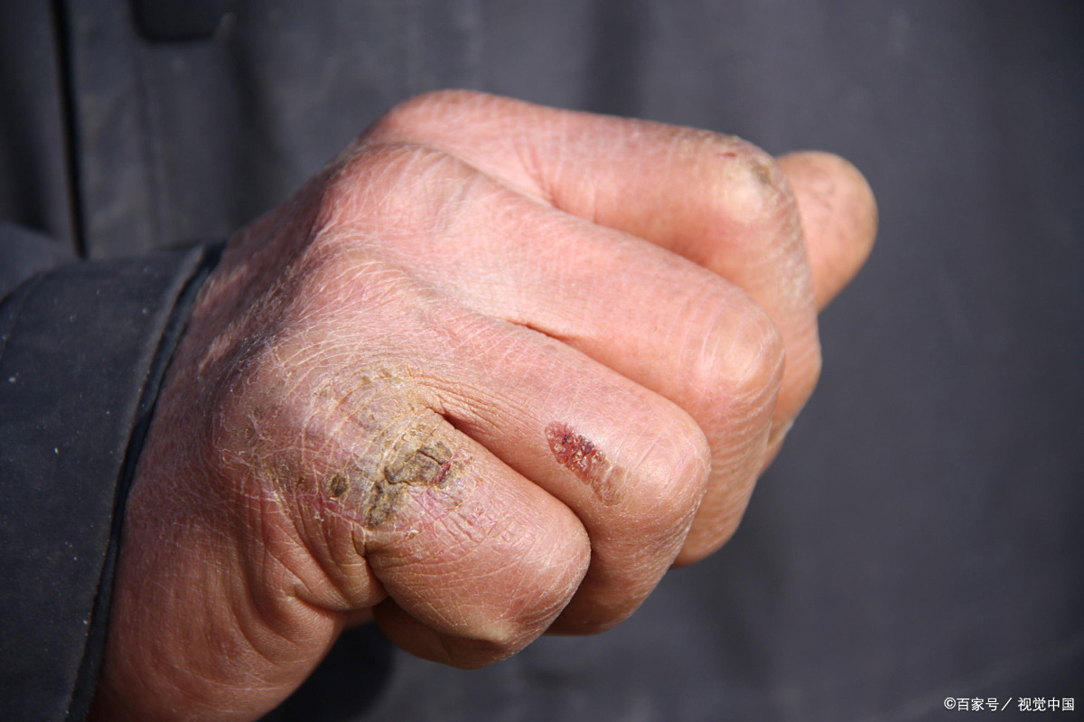 每到冬天,不少朋友的手都会被冻伤,真是让人苦恼