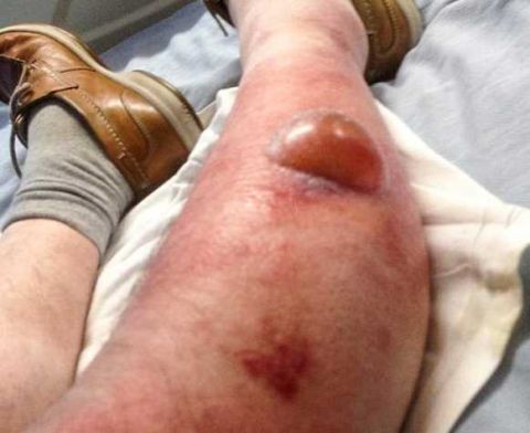 55岁男子在被蜘蛛咬伤后腿部严重感染 并渗出水泡