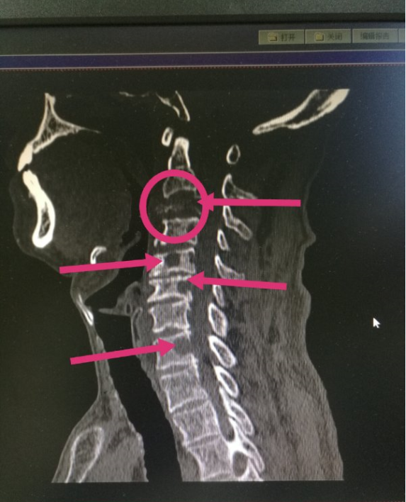 肺癌颈椎转移图片图片