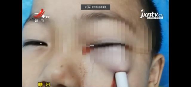 赣州 幼儿玩耍时铅笔不慎插进眼眶 差一毫米刺破眼球