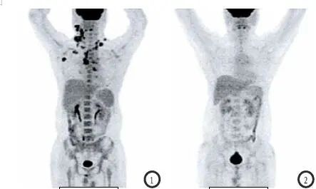 揭开「现代医学高科技之冠」PET/CT 的神秘面纱