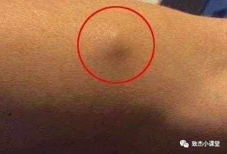 囊肿等于肿瘤吗?