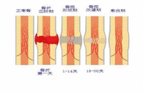 骨痂生长过程图 6月图片