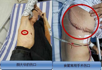 自贡市第一人民医院食管癌微创手术迈入国内前列