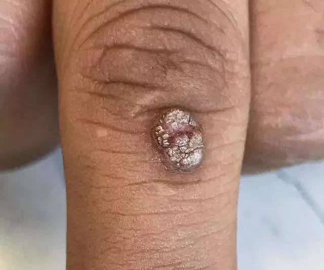 身上长瘊子难看又尴尬怎么办?瘊子有分公母吗?