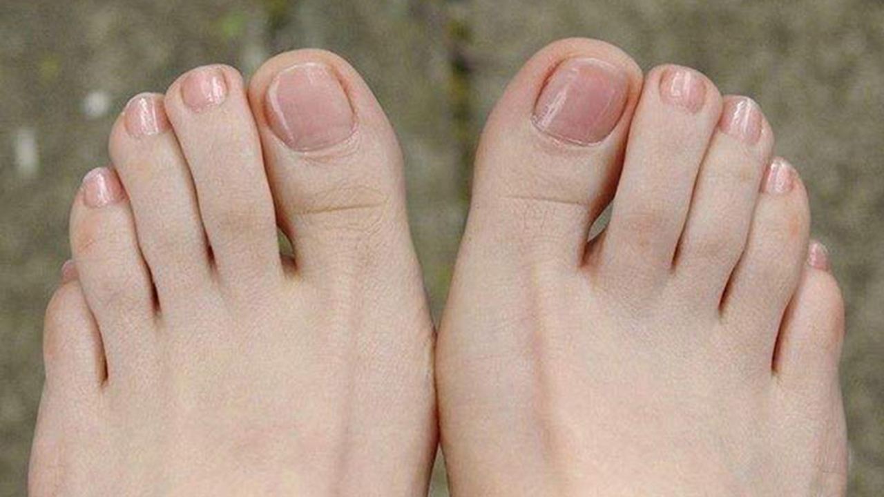 中国人的小脚趾,为什么有两瓣指甲,真的代表血统纯正的汉人吗