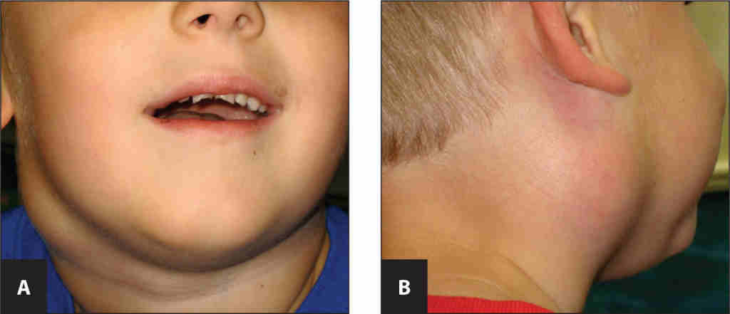 儿童颈部淋巴结肿大该怎么办?