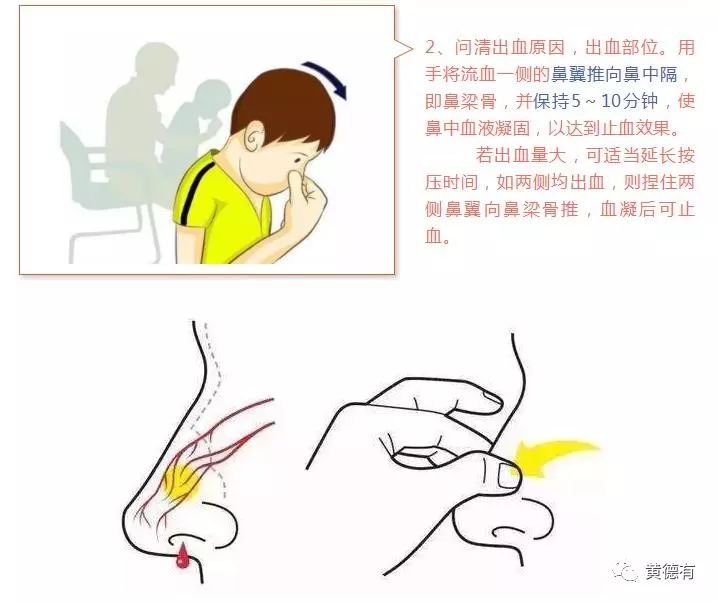 微讲堂(156)鼻出血的紧急处理与预防