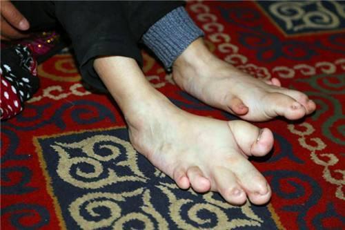11岁女孩长了只"巨人脚" 医生妙手巧治巨趾症