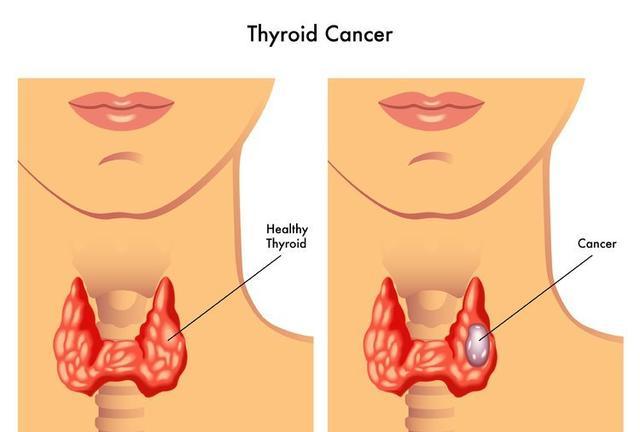 甲状腺癌症状表现图片图片