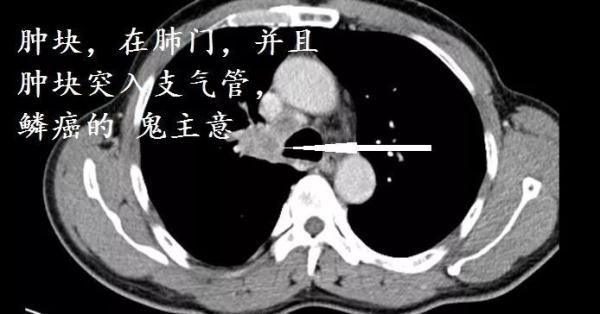 ct肺门位置图片