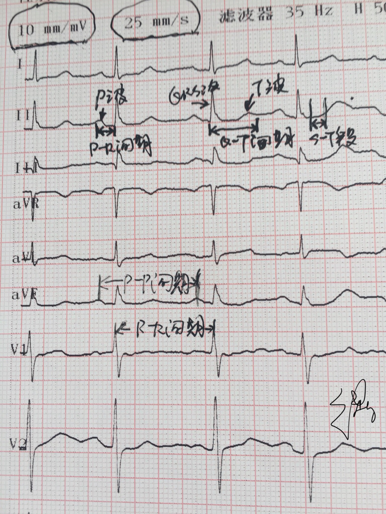 心电图rv5十sv1正常值图片