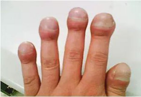 肺病手指头变大的图片图片