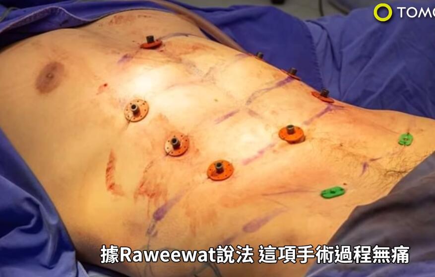 24岁泰国网红男模,通过手术整形出六块腹肌,大胆承认并感觉完美