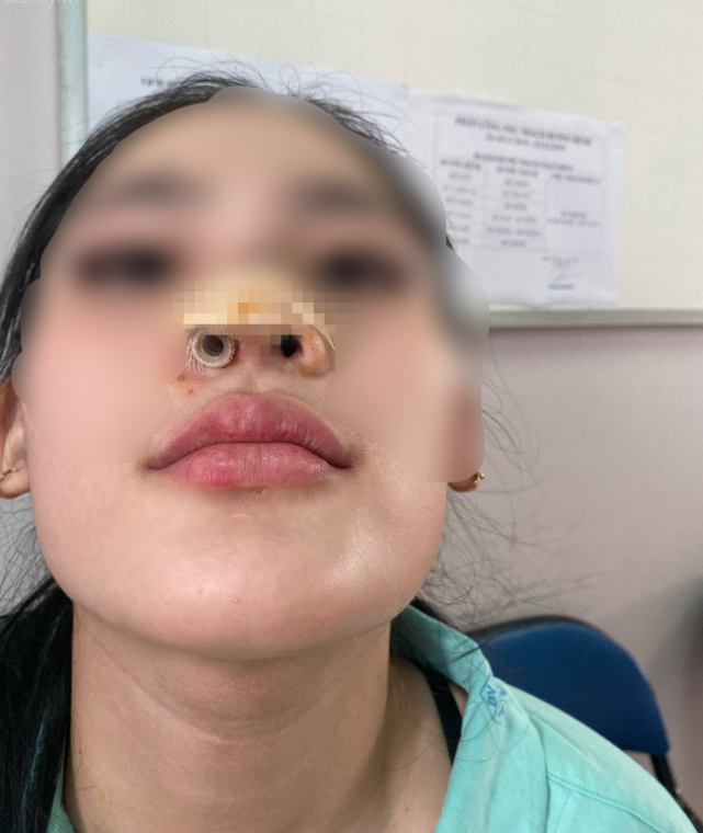 女孩去咨询变美方法结果被劝做隆鼻,如今鼻子变形悔不当初