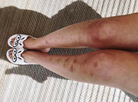 林允方回应腿部淤青:吊威亚及下水拍戏所致