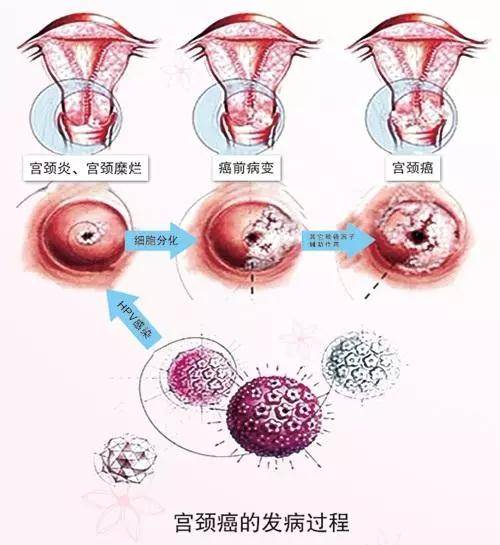 20岁大学生月经紊乱,宫颈癌晚期去世