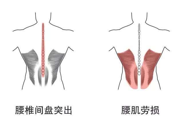 腰肌劳损还能运动吗?练练这些动作帮助快速恢复