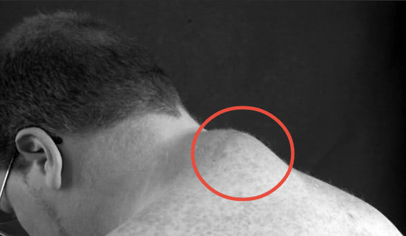 为什么有的人脖子后面会长"富贵包"?"富贵包"是什么?