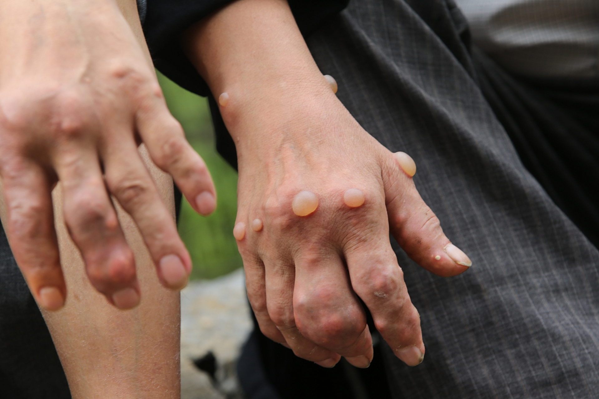 大家好,我是风湿科的郑医生,很多朋友上了年龄都会出现骨关节炎,风湿