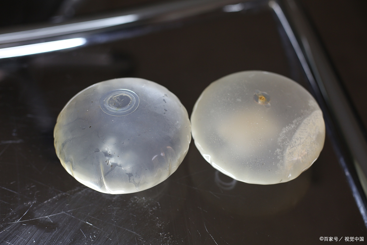 如果求美者的胸前组织量充足,我们就可以直接进行乳房假体的植入,以