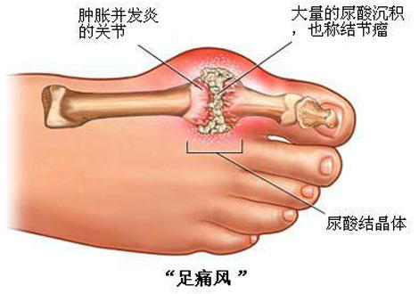 痛风能彻底治愈吗图片