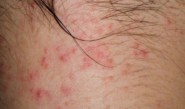 总是起湿疹是因为湿气重吗?我们应该如何预防湿疹?