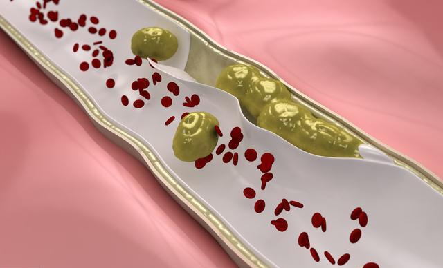 血脂高和血栓的形成有什么关系?血栓塞在不同部位会有什么后果?