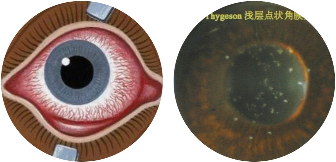 角膜后弹力层脱离图片