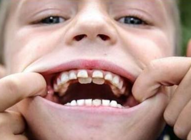 双排牙齿图片 小孩图片