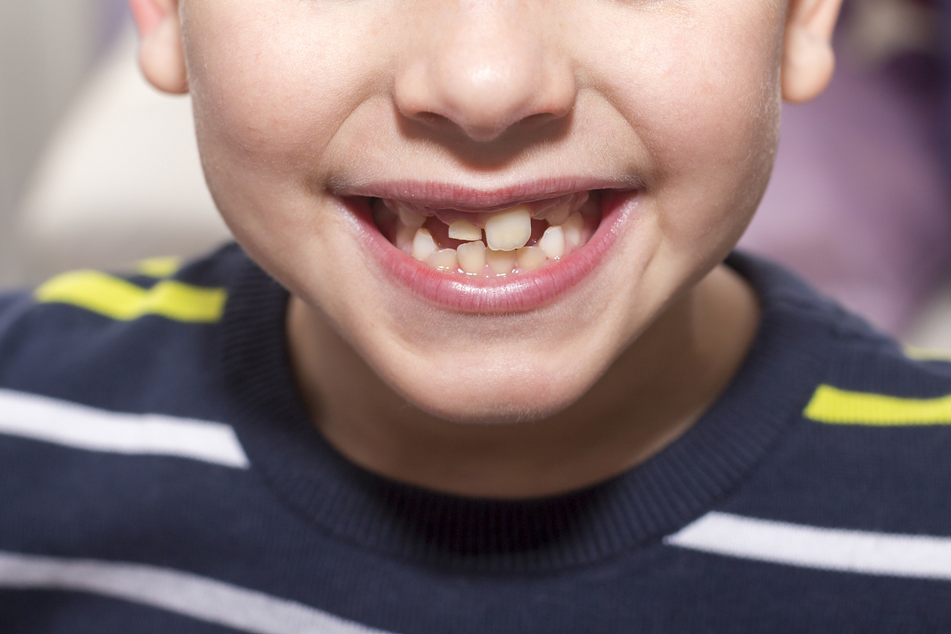 首先,我们得明确一个观点:小孩的牙齿不齐并不一定都