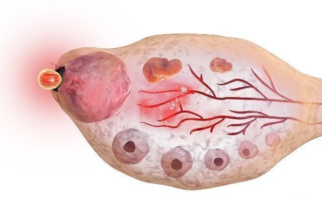 排卵一周后,若受精卵成功着床,身体或许会出现这3个变化!