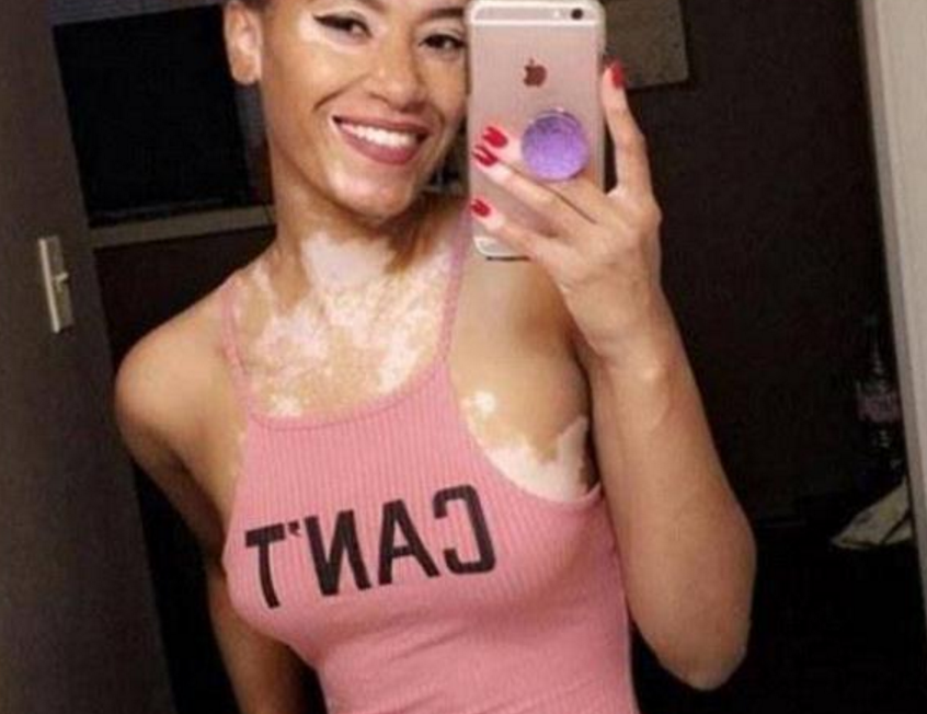 黑人女孩患白癜风,被人嘲笑为"斑点狗",如今成为著名女模特