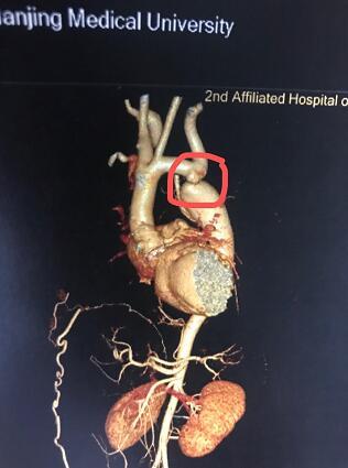 南医大二附院:恶性高血压,原来是主动脉打了个结