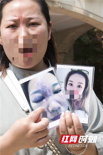 女子医美机构打玻尿酸隆鼻 术后昏迷视力严重下降