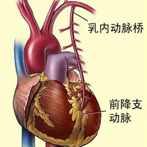 心脏搭桥手术 示意图图片