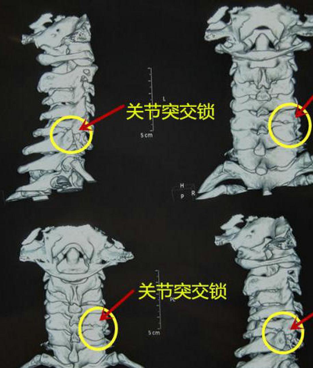 关节突交锁示意图图片