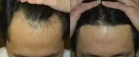 脱发,秃顶,发际线高,前额光秃.据说,它能让掉了的头发重新长出来!