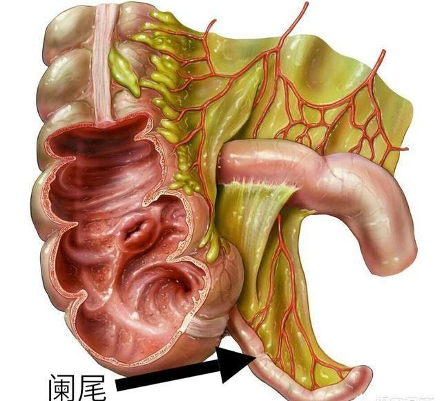 阑尾炎是什么呢?会怎样表现?