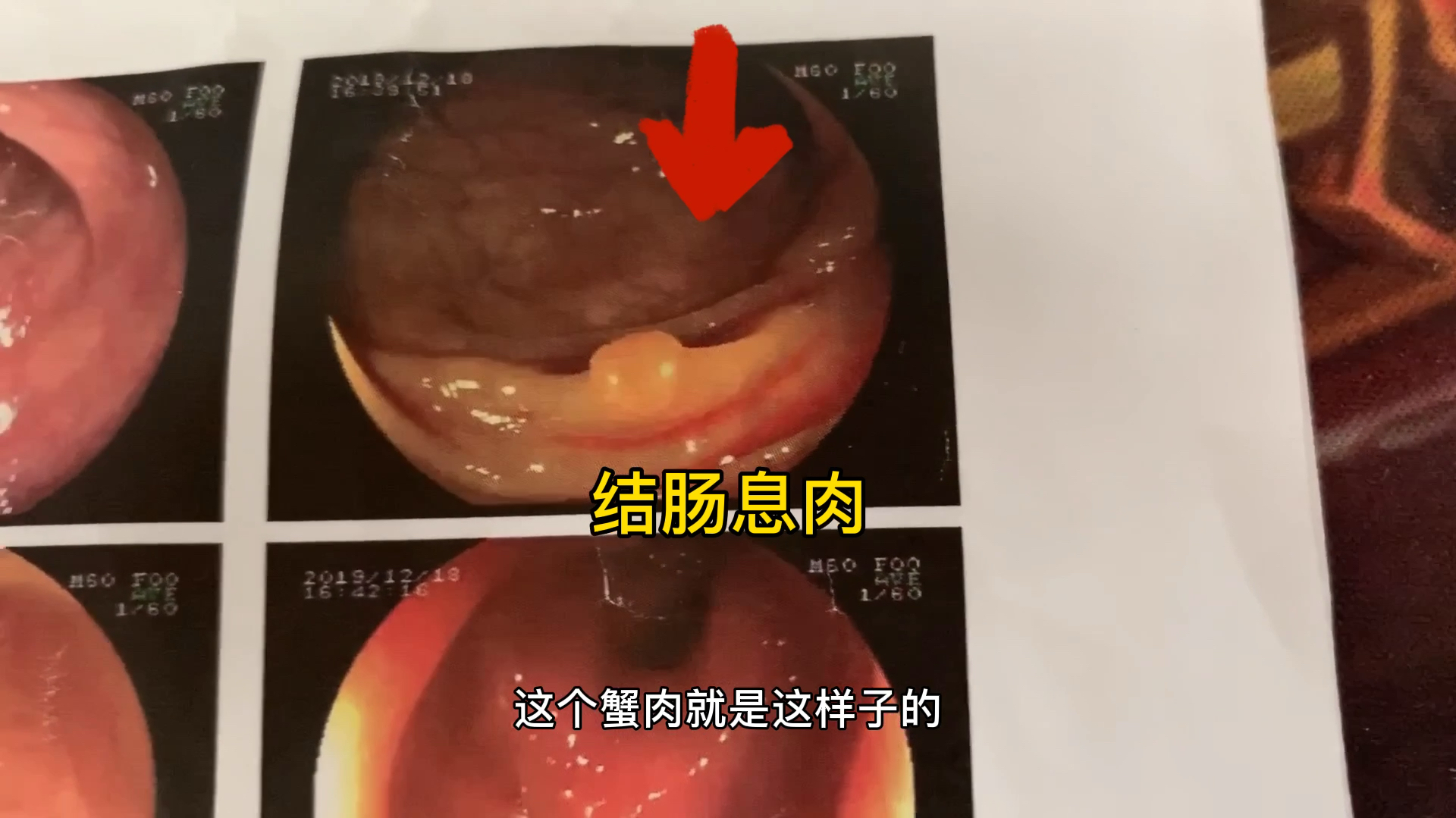 肠道息肉病理报告出来,结果给犹豫做检查的各位参考一下