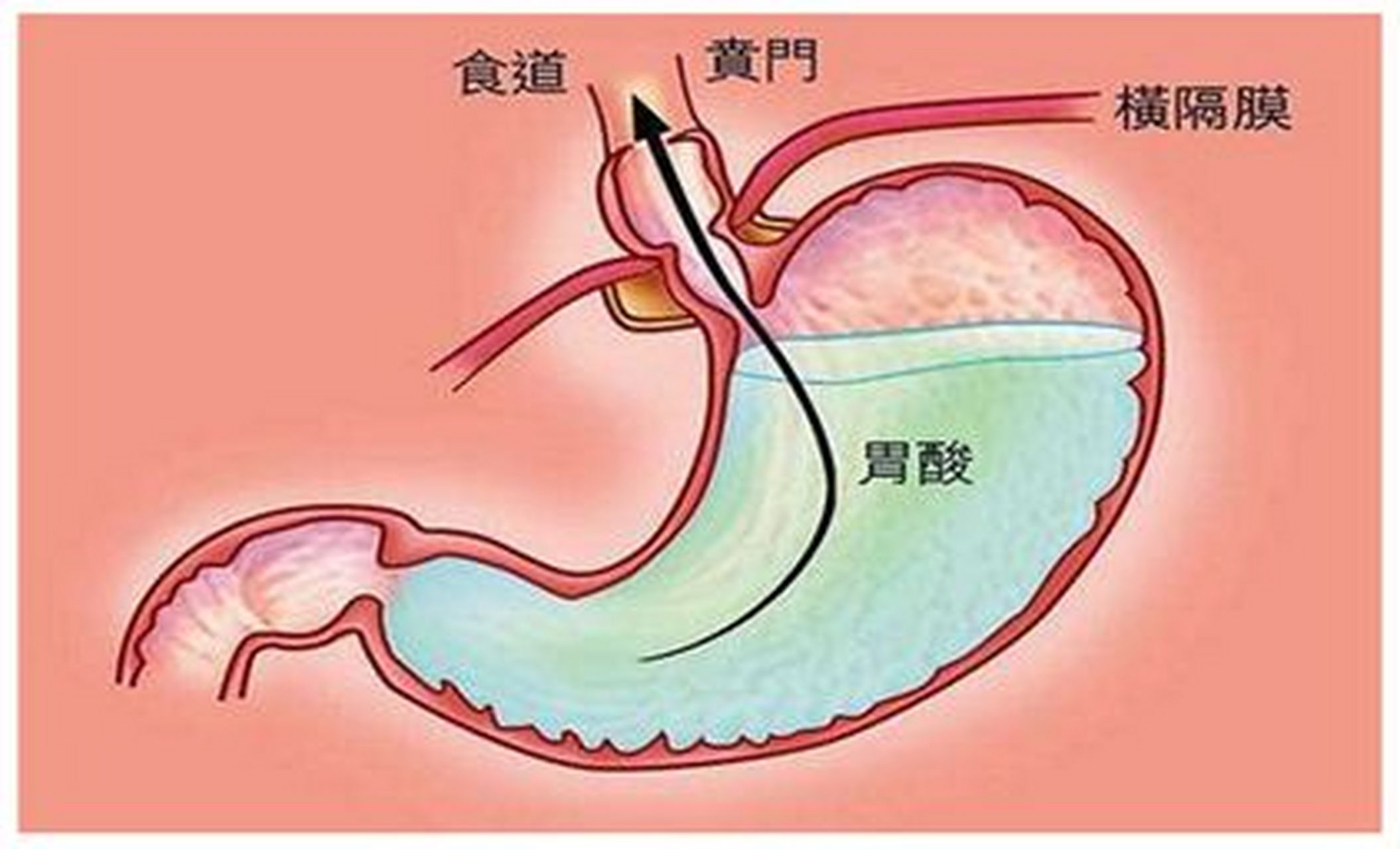 天阶计划#保健养生 胃返酸水,有哪些原因?