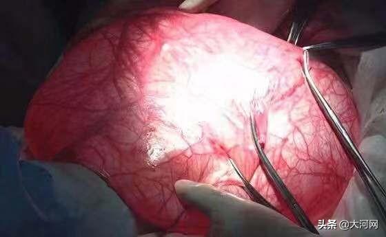 19岁女生腹部像怀孕,医生从10厘米切口取出18斤重包块