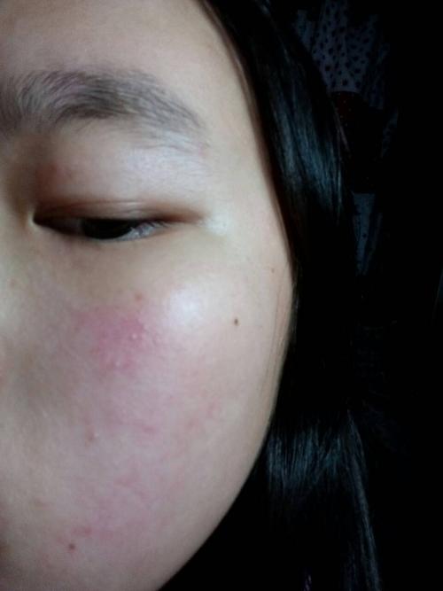 过敏性皮炎的分类和处理?
