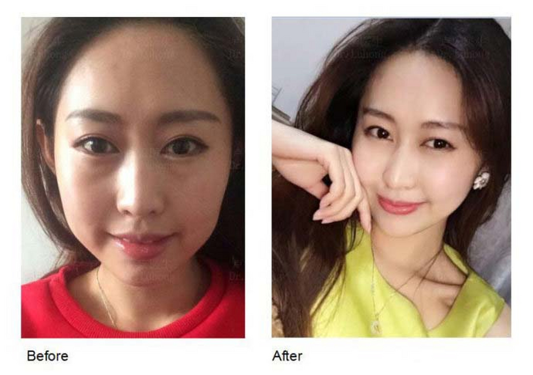 以前流行锥子脸,瓜子脸,最近两年心形脸开始流行,饱满的额头太阳穴